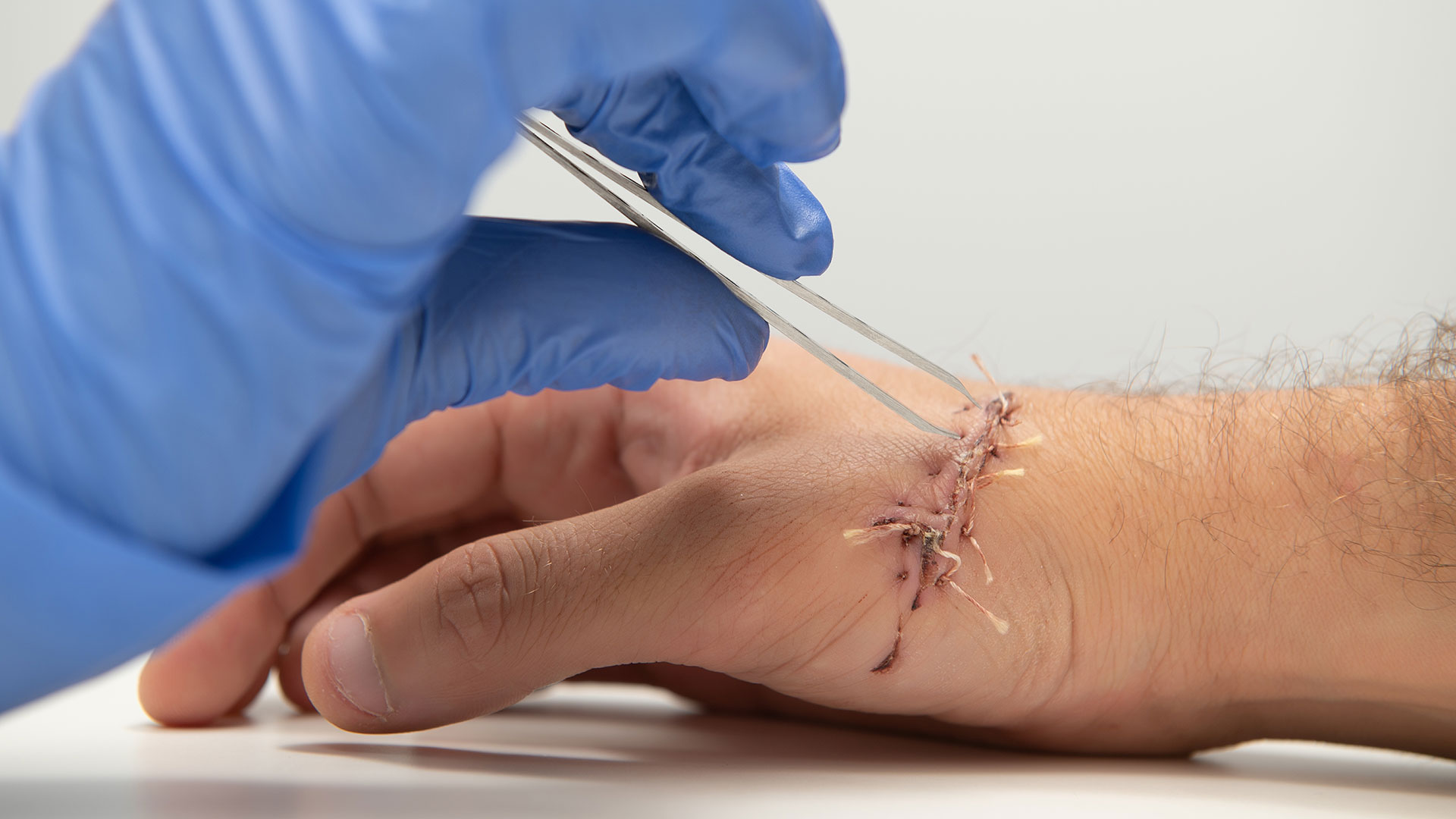 Non-Absorbable Sutures